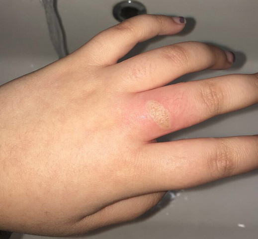Kleine Verbrennung Am Finger Wegen Ofen Gesundheit Chemie Verletzung Kleine Verbrennung Am Finger Wegen Ofen Gesundheit Chemie Verletzung