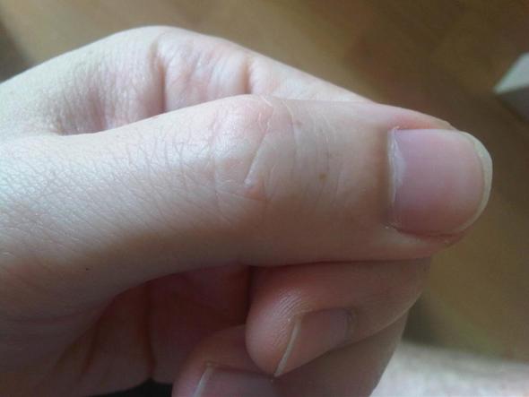 Kleine Wasserblaschen An Den Fingern Was Kann Das Sein Blase Hautkrankheit Kleine Wasserblaschen An Den Fingern Was Kann Das Sein Blase Hautkrankheit