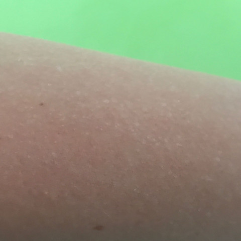 Kleine Weisse Flecken An Den Armen Haut Arm Weisse Flecken Kleine Weisse Flecken An Den Armen Haut Arm Weisse Flecken