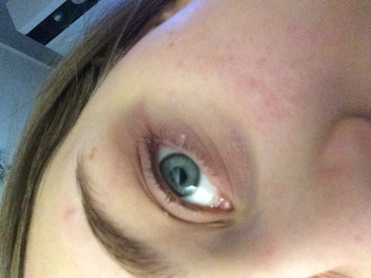 Kleine Weisse Pickel Schmerzen Haut Weiss