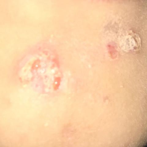 Kleine Wunde Im Gesicht Nun Heilt Es Nicht Und Wird Grosser Mit Bild Ekelig Gesundheit Und Medizin Haut Pickel Kleine Wunde Im Gesicht Nun Heilt Es Nicht Und Wird Grosser Mit Bild Ekelig Gesundheit Und Medizin Haut Pickel