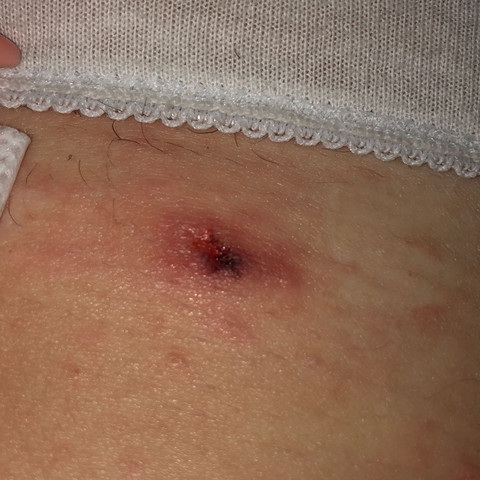 Kleine Wunden Am Korper Verteilt Gesundheit Und Medizin Haut Wunde Kleine Wunden Am Korper Verteilt Gesundheit Und Medizin Haut Wunde