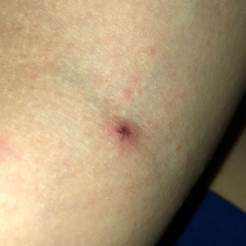 Kleine Wunden Am Korper Verteilt Gesundheit Und Medizin Haut Wunde Kleine Wunden Am Korper Verteilt Gesundheit Und Medizin Haut Wunde