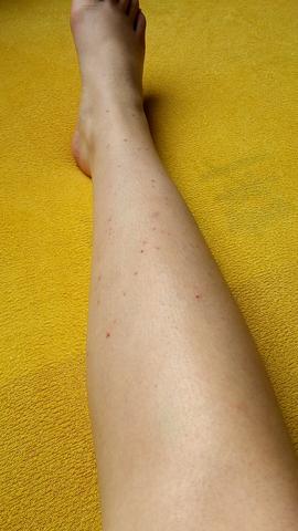 Kleine Wunden An Den Beinen Nach Der Rasur Haut Beine Rasieren