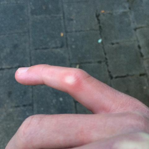 Kleiner Finger Gebrochen Oder Was Tut Weh Kleiner Finger Gebrochen Oder Was Tut Weh