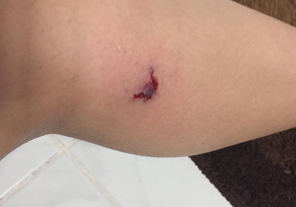 kleiner hundebiss, kann ich abwarten und es heilen lassen? (Gesundheit