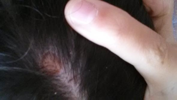 Kleiner Knubbel Am Hinterkopf Was Konnte Das Sein Kopfhaut Kleiner Knubbel Am Hinterkopf Was Konnte Das Sein Kopfhaut
