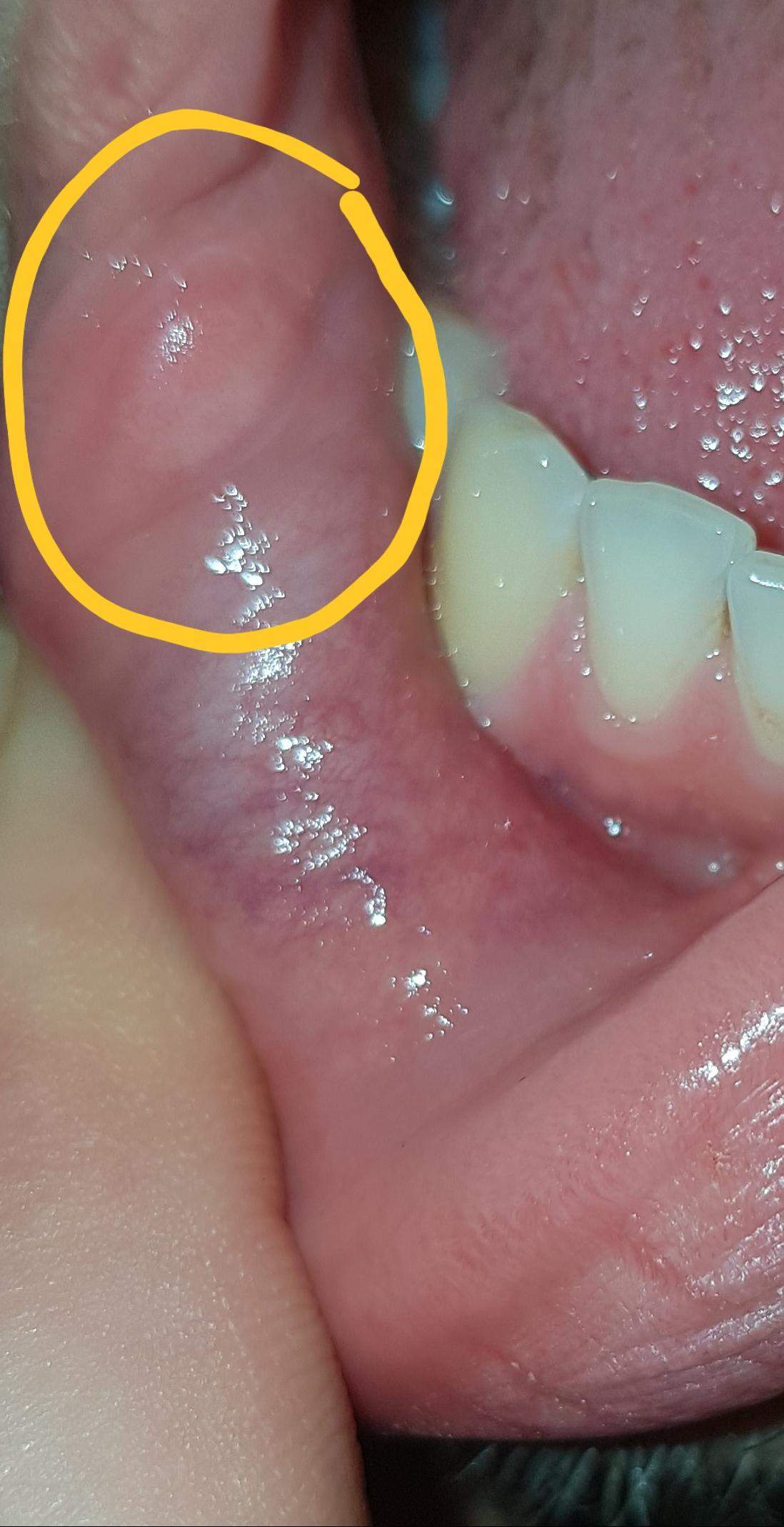 Kleiner knubbel an der lippeninnenseite/wangenschleimhaut, hat jemand Ahnung? (Gesundheit und