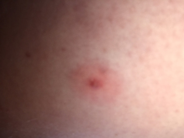 Kleiner Pickel am Oberschenkel, was ist das und wie kann ich das Behandeln? (Haut) pickel an oberschenkel