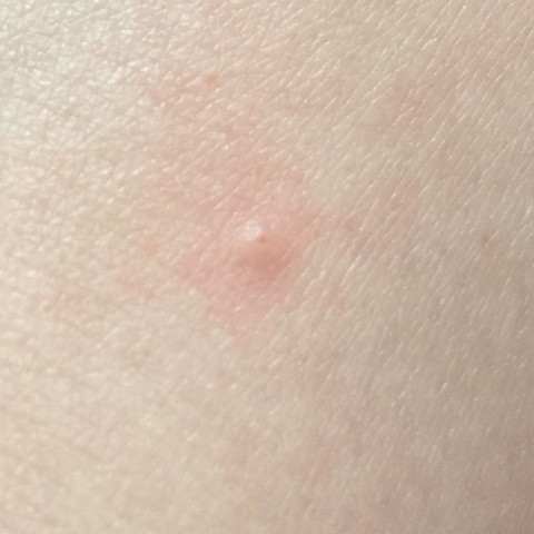 Kleiner Pickel Auf Dem Handrucken Muss Ich Mir Sorgen Machen Hand Warzen Kleiner Pickel Auf Dem Handrucken Muss Ich Mir Sorgen Machen Hand Warzen