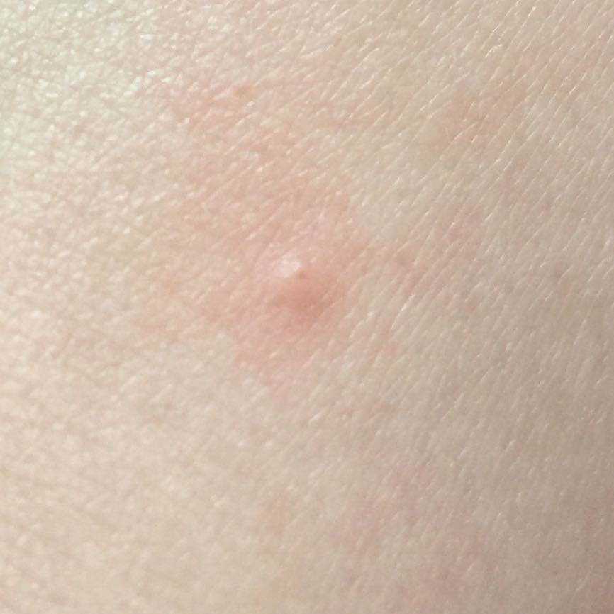 Download Kleiner Pickel Auf Der Zungenspitze Pics