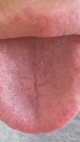 Kleiner Riss Auf Der Zunge Normal Gesundheit Und Medizin Kleiner Riss Auf Der Zunge Normal Gesundheit Und Medizin