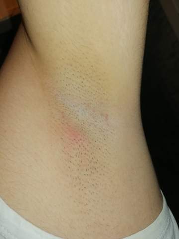 Kleiner Roter Buckel Unter Den Achseln Was Ist Das Gesundheit Und Medizin Arzt Kleiner Roter Buckel Unter Den Achseln Was Ist Das Gesundheit Und Medizin Arzt