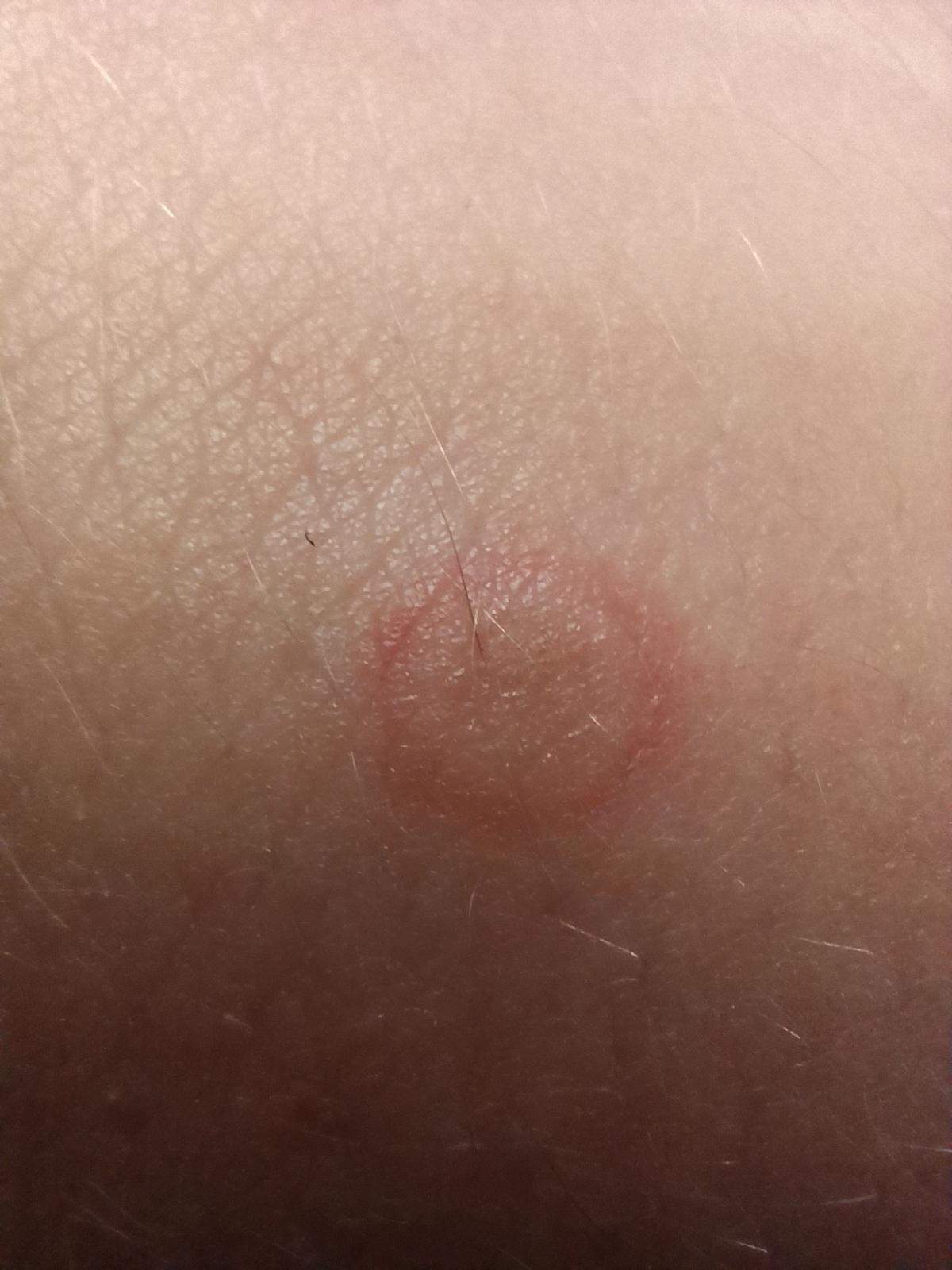 Kleiner Roter kreis auf der haut?