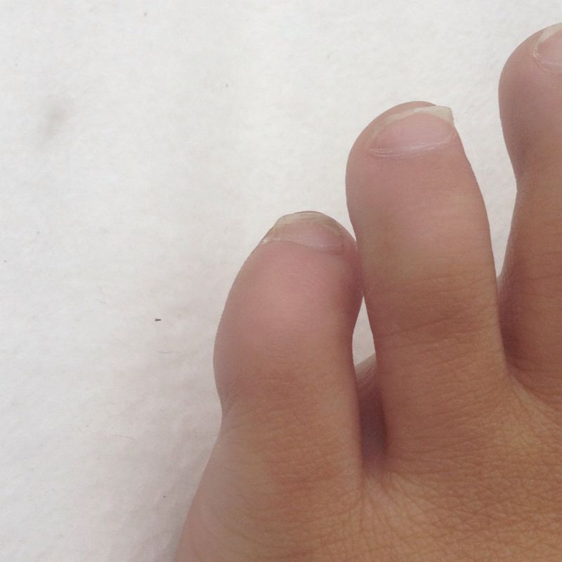 Kleiner Zeh komisch geformt (Arzt, Körper, Schmerzen) Kleiner Zeh komisch geformt (Arzt, Körper, Schmerzen)