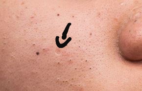 Kleines Loch Im Gesicht Haut Unreine Haut Kleines Loch Im Gesicht Haut Unreine Haut