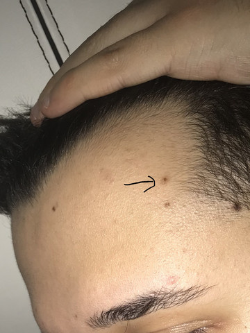 Stanzen muttermal Muttermal ausstanzen