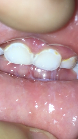 Zähne - (Gesundheit, Zähne, Kleinkind)