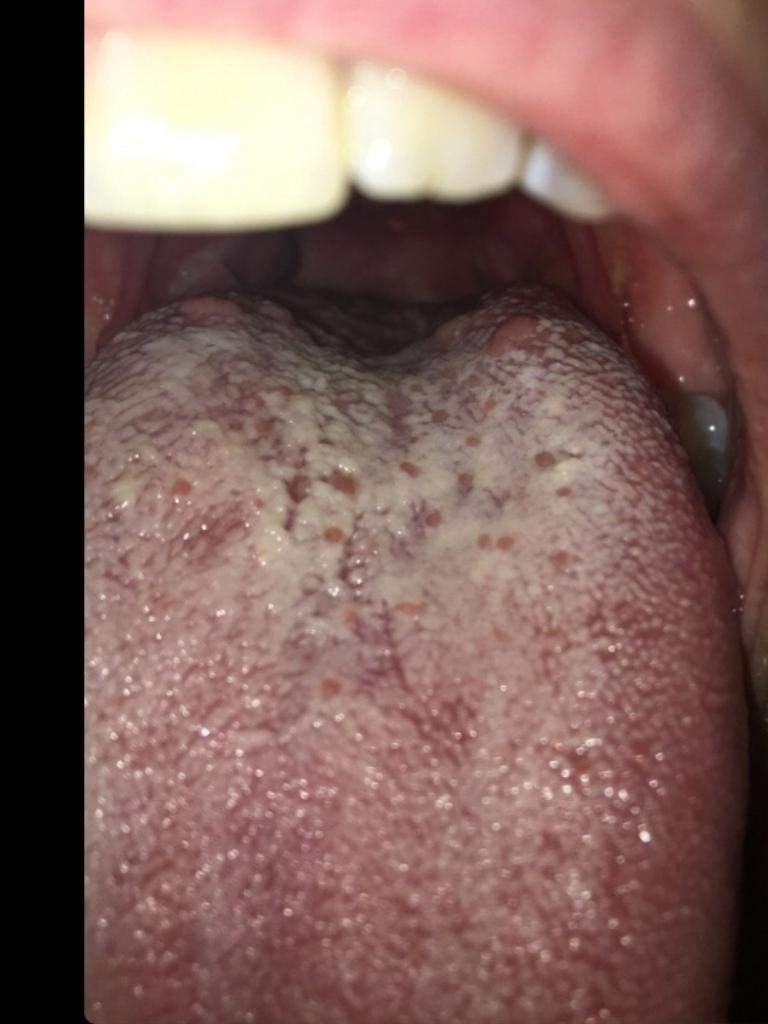 Kmische Flecken und Belag auf Zunge wass ist das? (Gesundheit und