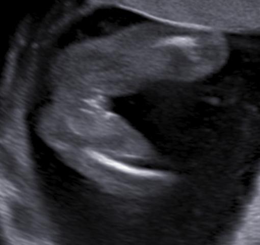 Ultraschallbild 18 SSW - (Kinder, Schwangerschaft, Geschlecht)