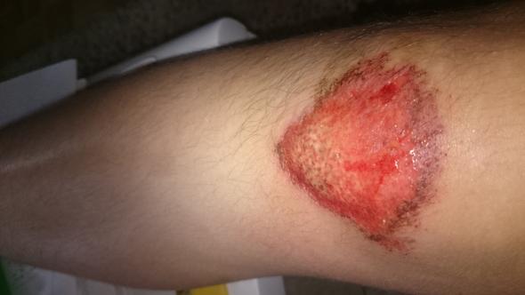 - (Knie, Wunde)