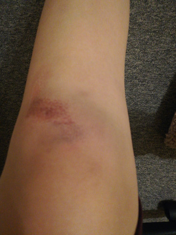Knie Dick Und Blau Nach Sturz Was Kann Das Sein Sport Schmerzen Fussball Knie Dick Und Blau Nach Sturz Was Kann Das Sein Sport Schmerzen Fussball
