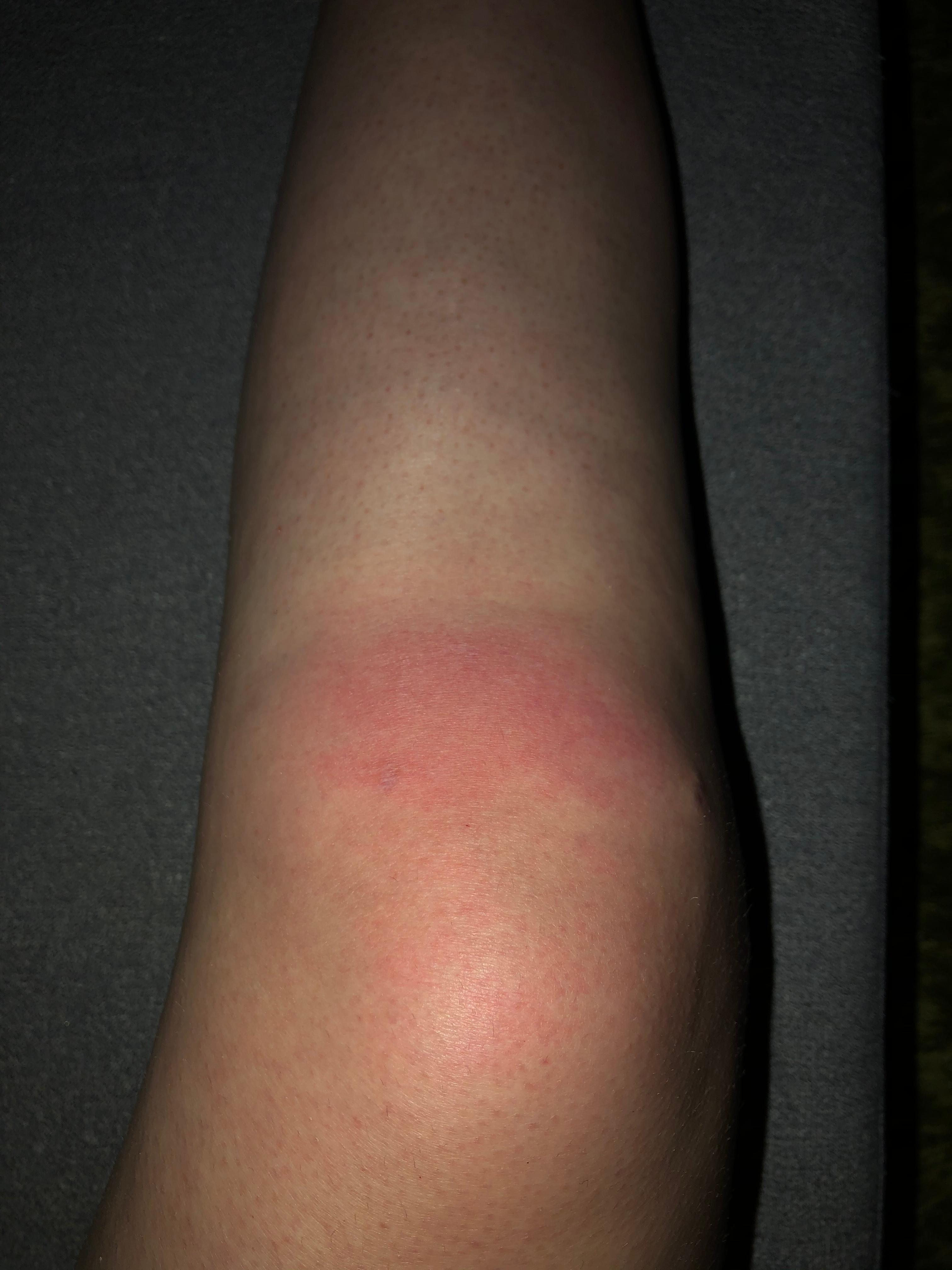 Knie Op 1 Jahr her, Knie wird wieder rot und schmerzt? (Gesundheit und Medizin)