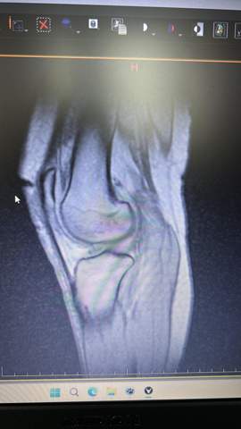 Knie sehne gerissen?? (Knochen, Orthopäde, Orthopädie)