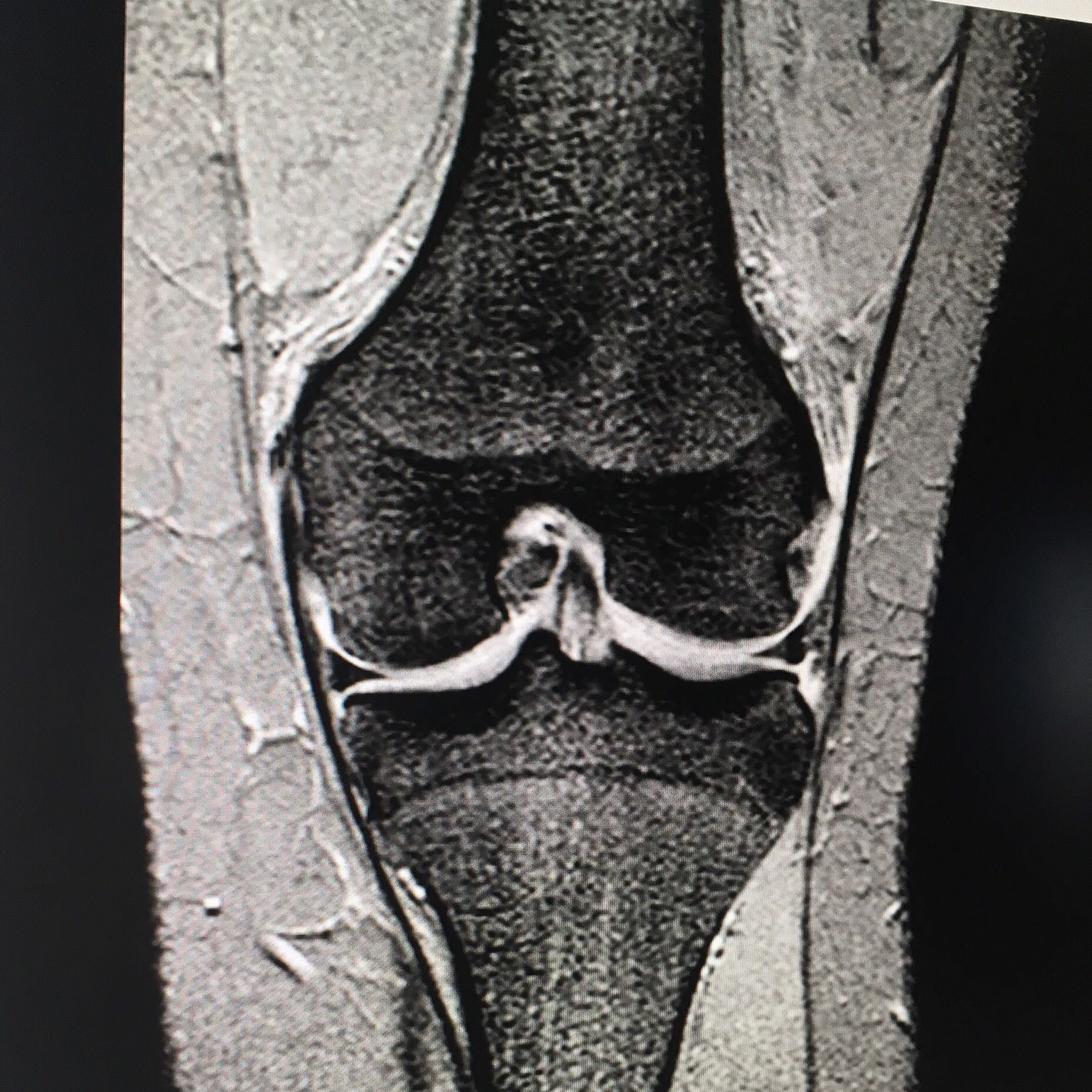 Knie verdreht Bänder beschädigt? MRTBilder bekommen, aber