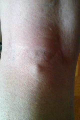 Kniekehle Tut Weh Was Konnte Das Sein Schmerzen Kniekehle Tut Weh Was Konnte Das Sein Schmerzen