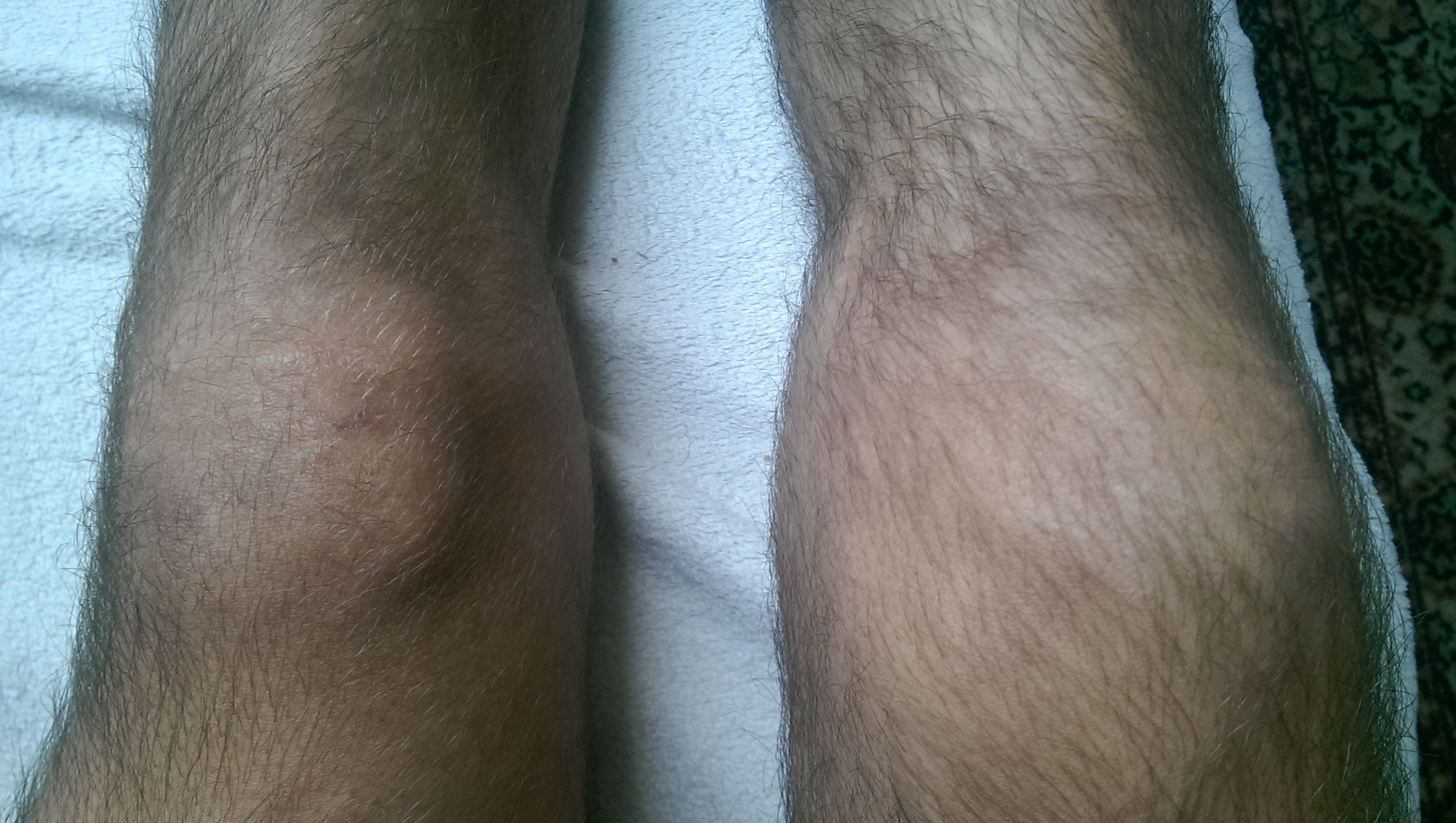 Knieschmerzen, kreuzbandriss,meniskus oder nur verstauchung? (arzt knieschmerzen, kreuzbandriss,meniskus oder nur verstauchung? (Arzt