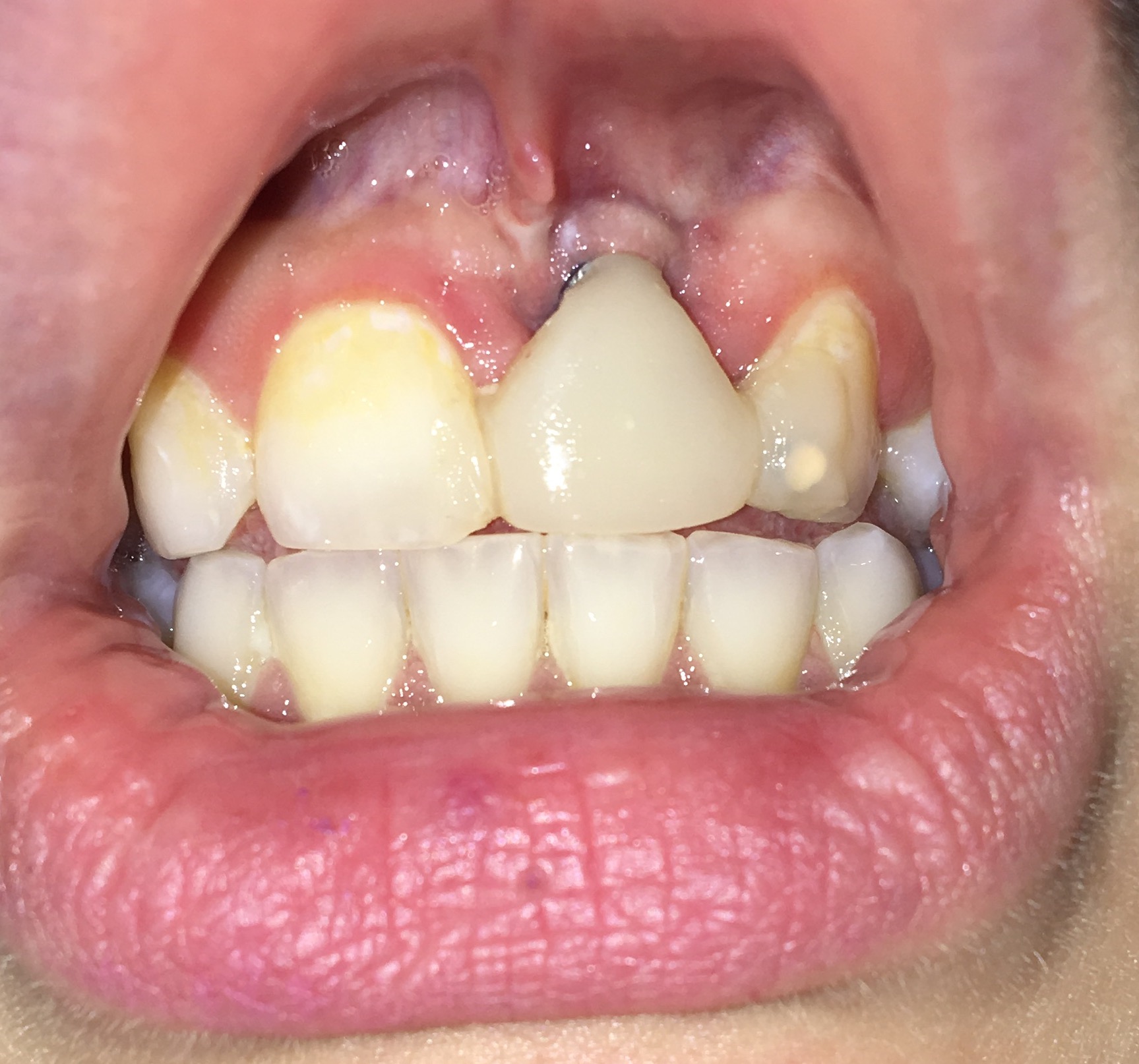 Knochenaufbau für Implantat ? (Zähne, Zahnarzt, OP)