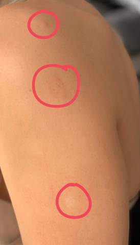Knotchen Roter Rauer Fleck Haut Ausgeblichen Juckreiz Was Konnte Das Sein Gesundheit Und Medizin Gesundheit Hautarzt Knotchen Roter Rauer Fleck Haut Ausgeblichen Juckreiz Was Konnte Das Sein Gesundheit Und Medizin Gesundheit Hautarzt