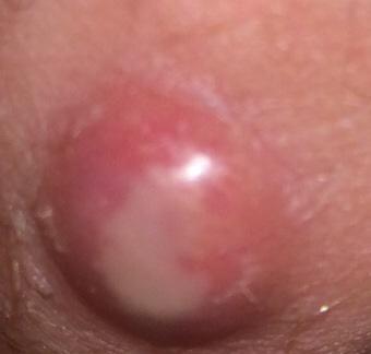 Weiss Jemand Was Dieser Knorpel Oder Pickel Ist Schmerzen Intimbereich Weiss Jemand Was Dieser Knorpel Oder Pickel Ist Schmerzen Intimbereich