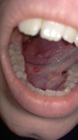 33+ Rote Pickel Auf Der Zunge Hinten Gif