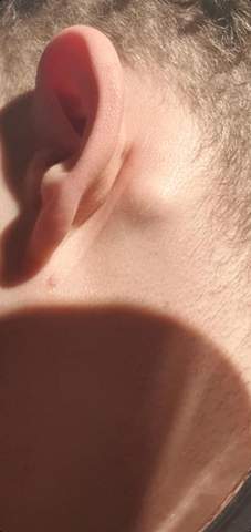 Knoten Lymphknotenschwellung Knoten Lymphknotenschwellung
