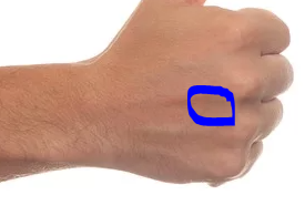 Knoten Auf Der Oberseite Der Hand Gesundheit Und Medizin Knoten Auf Der Oberseite Der Hand Gesundheit Und Medizin