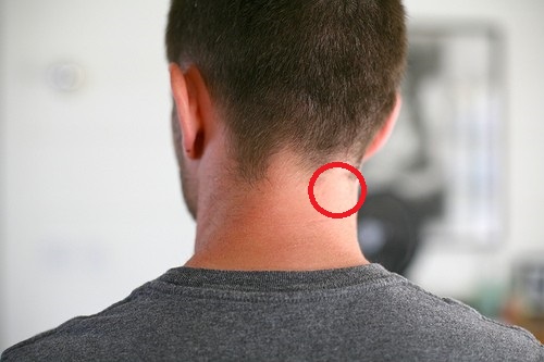 Knoten Im Nacken O Gesundheit Knoten Im Nacken O Gesundheit