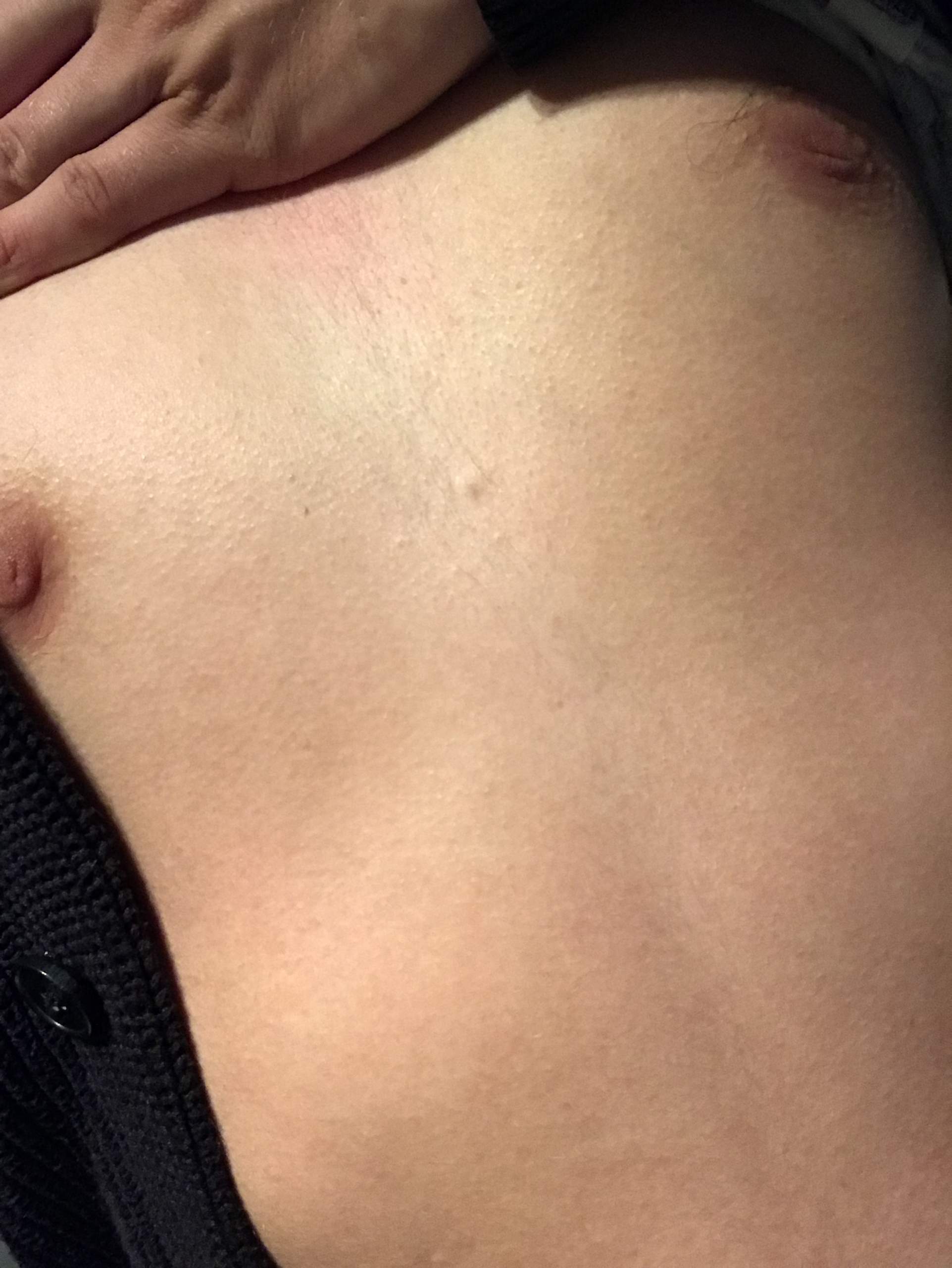 Knoten Knubbel in der Brust? (Gesundheit und Medizin, Knubbel unter Haut,  Knoten in Brust)