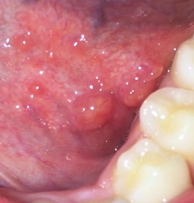 Download Pickel Auf Der Zunge Corona Pics