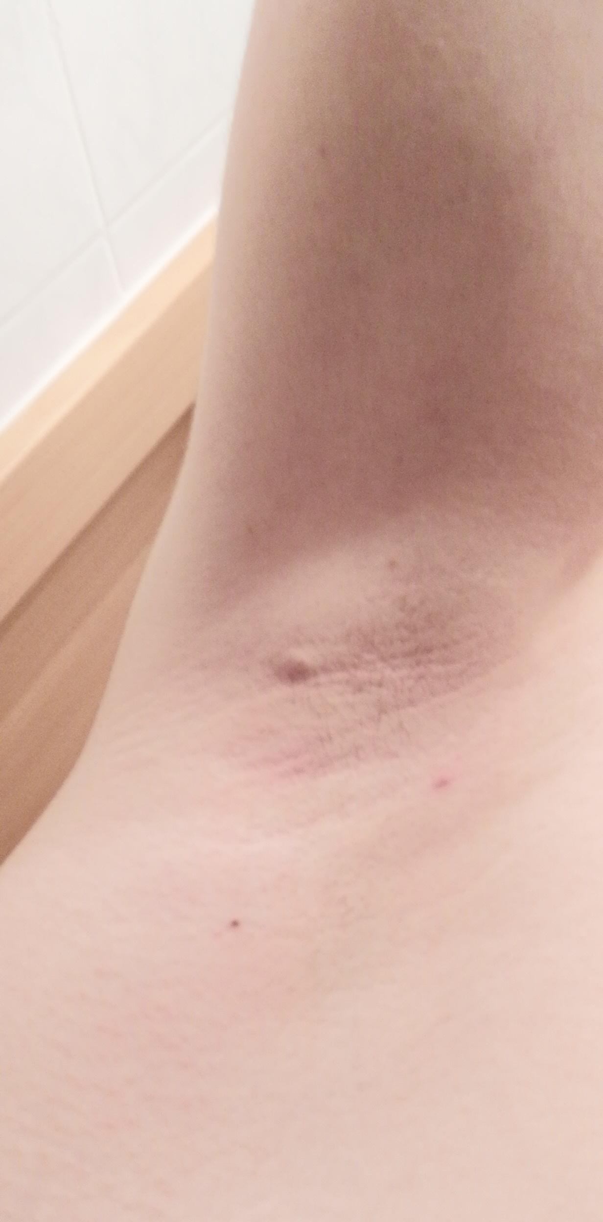 knoten unter der achsel