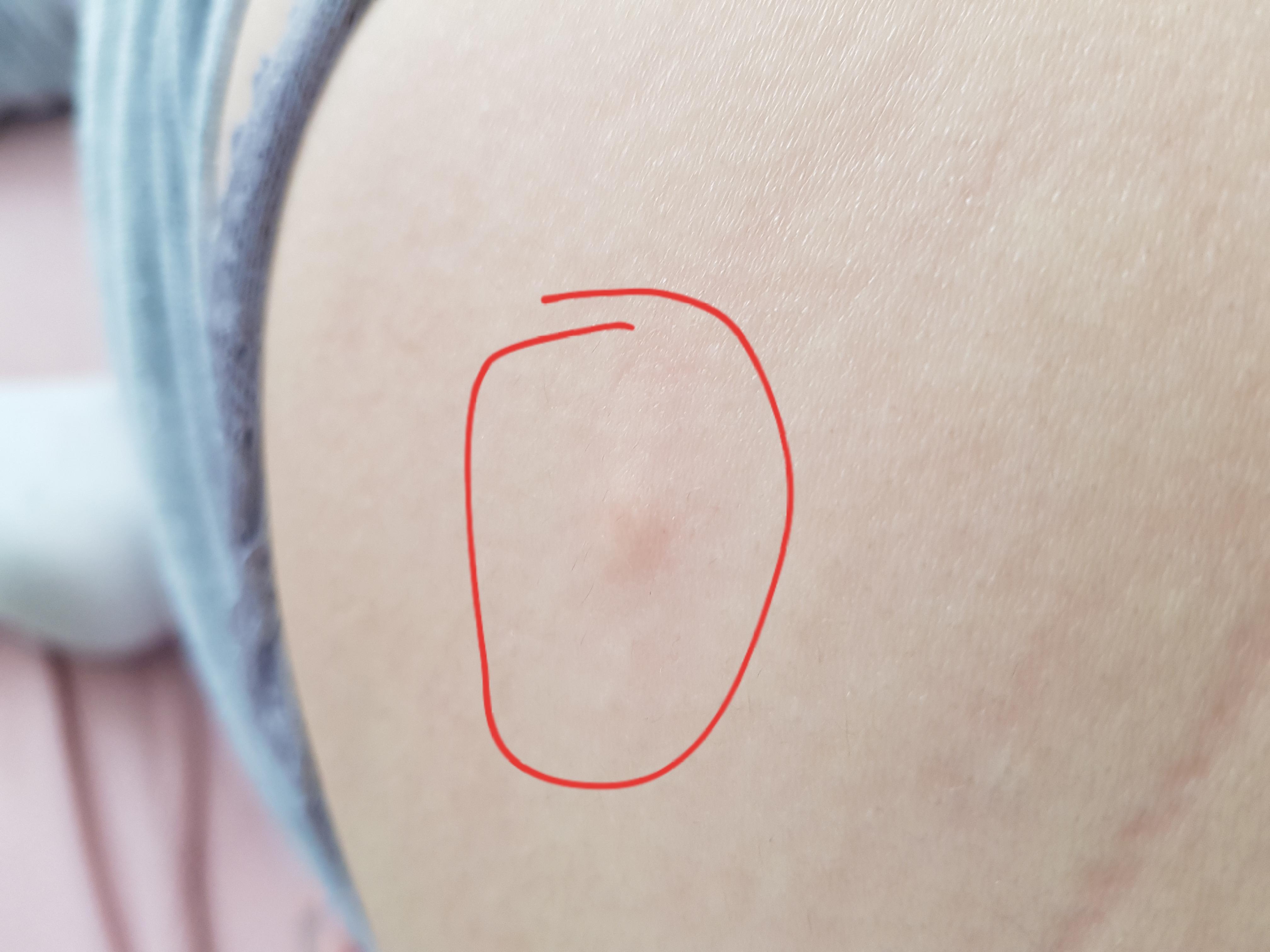 Knoten unter der Haut Hatte es jemand von euch? (Gesundheit) Knoten unter der Haut Hatte es jemand von euch? (Gesundheit)