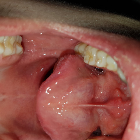 Knoten Unter Der Zunge Was Ist Das Arzt Krankheit Knoten Unter Der Zunge Was Ist Das Arzt Krankheit