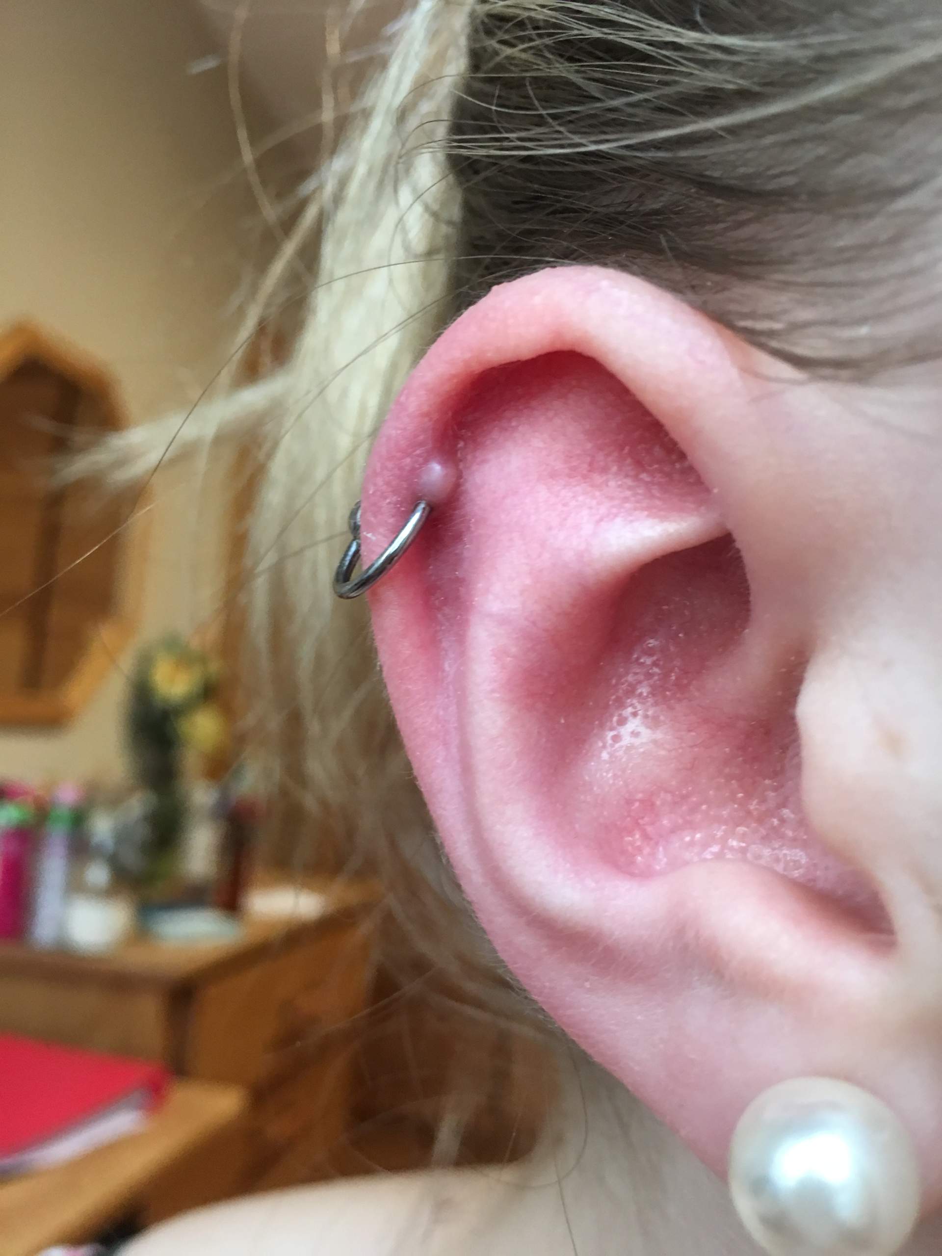 Knubbel am Einstechkanal des Helix? (Piercing, Entzündung, Piercer)