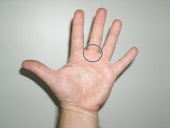 Knubbel Am Finger Innen Medizin Orthopadie Knubbel Am Finger Innen Medizin Orthopadie
