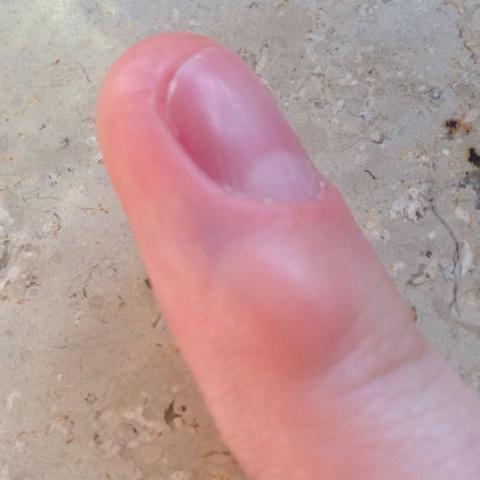 Knubbel Am Finger Was Ist Das Gesundheit Medizin Hand Knubbel Am Finger Was Ist Das Gesundheit Medizin Hand