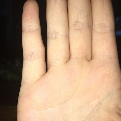 Der kleine Finger innen am Gelenk  - (Verletzung, Hand, Finger)