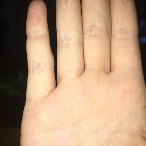 Knubbel Am Gelenk Vom Kleinen Finger Verletzung Hand Knubbel Am Gelenk Vom Kleinen Finger Verletzung Hand