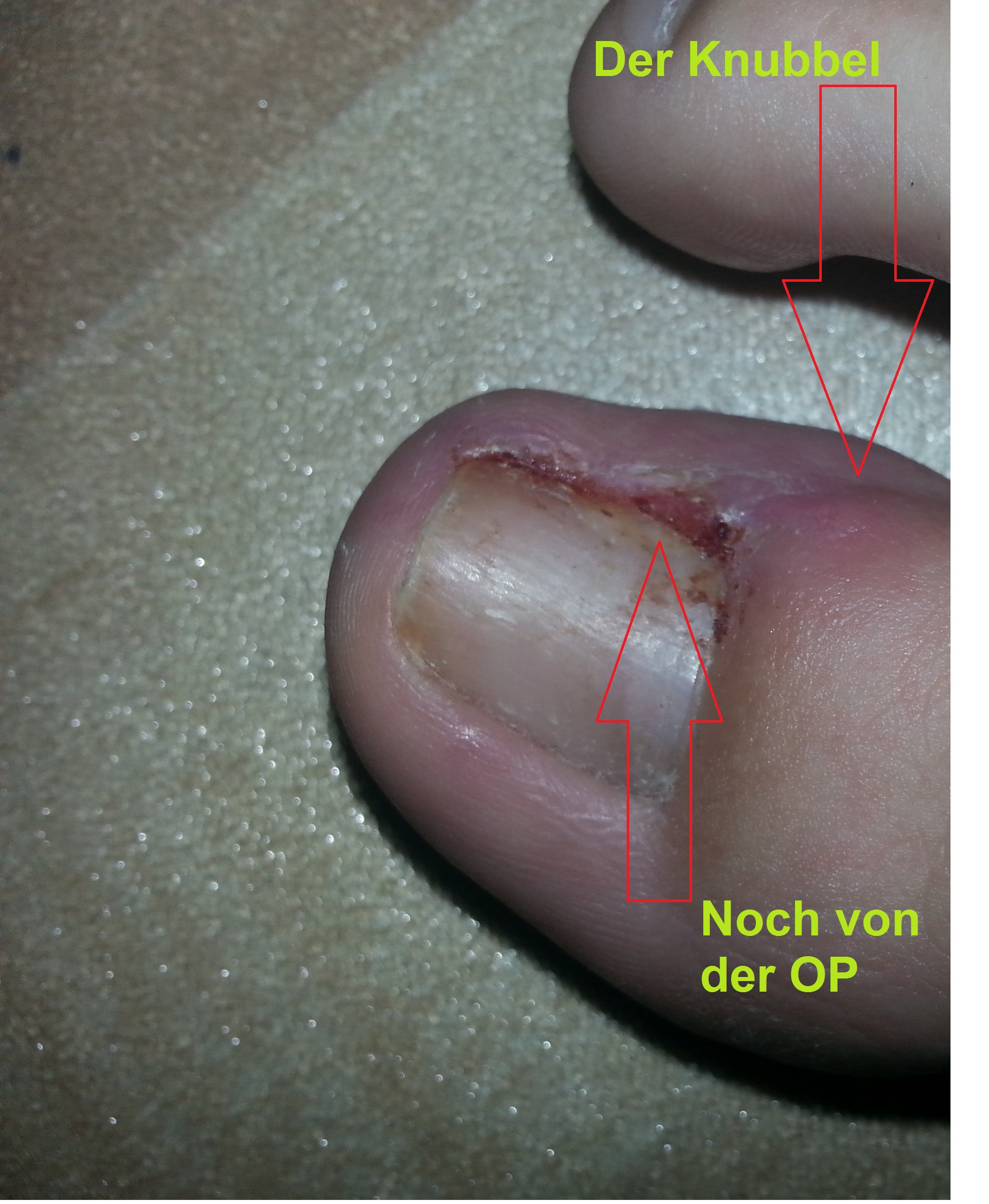 Knubbel am großen Zeh (Wunde, bilden)