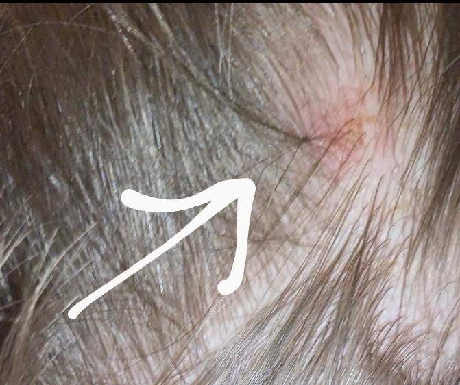 Knubbel Beispiele | Was ist ein Ganglion? – IVEWAP